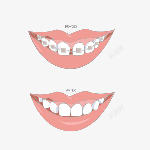 卡通矫正牙齿前后对比插画png免抠素材_新图网 https://ixintu.com 前后对比 卡通 嘴唇 嘴巴 图示 牙套 牙科 矫正牙齿