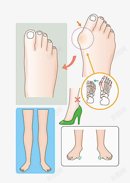 手绘骨骼错位png免抠素材_新图网 https://ixintu.com 脚 骨 骨头 骨质 骨骼 骨骼结构 骨骼错位 骨髓