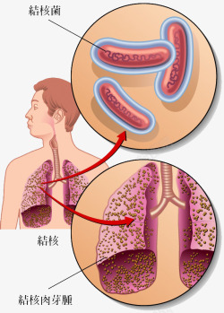 肺结核结核病结构高清图片