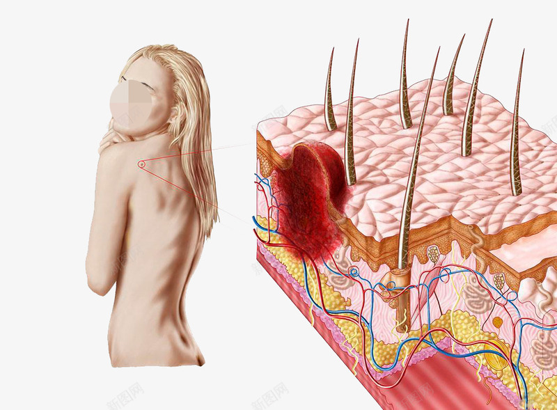 美容医疗图png免抠素材_新图网 https://ixintu.com 医学人体结构 卡通痘痘 痘痘 肌肤组织