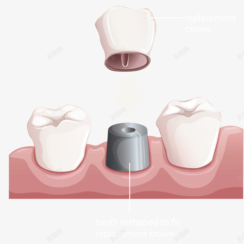 牙齿救护png免抠素材_新图网 https://ixintu.com 医疗研究 手绘 模型 观察 齿根